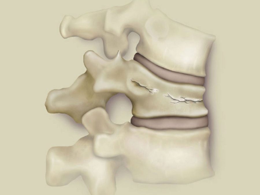 When Low Back Pain could be a Compression Fracture