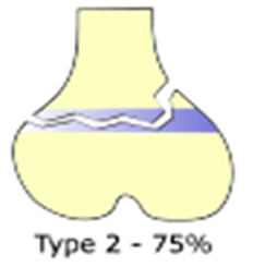 Growth Plate Injuries
